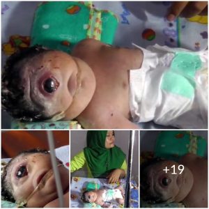 Unprecedented and Unusual: One-Eyed Baby’s Birth Leaves Many Frightened
