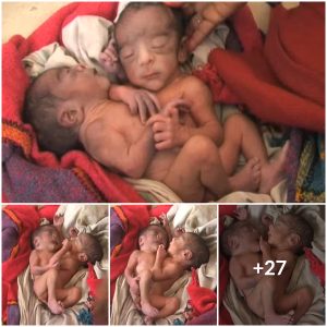 Miraculous baby born with 2 heads, 4 arms and 2 legs in India(VIDEO)