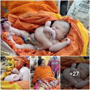 Community in Awe as Four-Armed, Four-Legged Baby Becomes Local Sensation