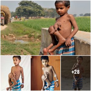 Heartbreaking hope: Baby with extra limbs carries a message of hope in West Bengal