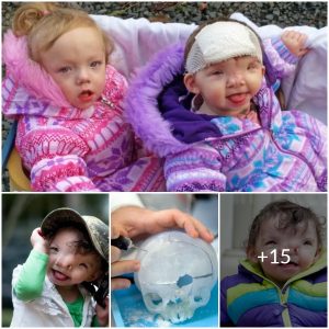 A new face for a new life: the remarkable journey of a baby girl and her surgeon(Video)
