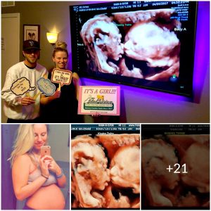 Magical Moment in the Womb: Twins Captured Kissing in Stunning Ultrasound