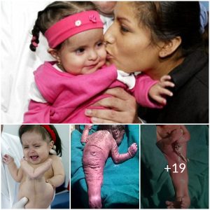 The Enigma of the ‘Mermaid’ Baby: Decoding the Baffling Case Baffling Doctors and Scientists