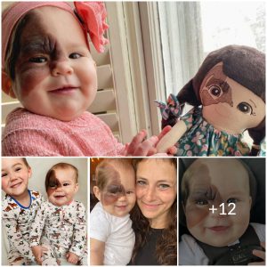 Born to Stand Out: Little Winry’s Journey with a Rare Birthmark
