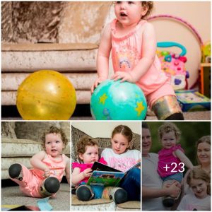 A Difficult Decision: Parents Choose Amputation to Spare Toddler Years of Pain