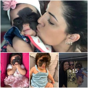 The Mark of a Hero: Celebrating the Unique and Beautiful Birthmark of a Little Girl