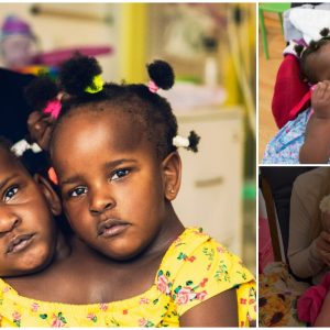 Conjoined twins separation: The emotional and medical challenges faced by hospitals and families