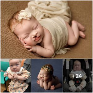 A New Reason to Smile: Congratulations to Baby Who Triumphed Over Tough Surgery